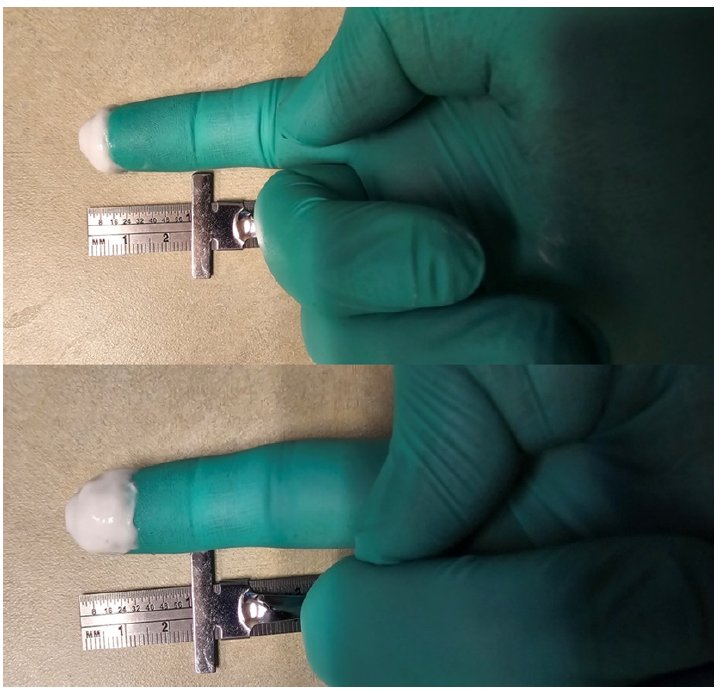 Figure 1. Simple use of nitroglycerin ointment using index finger for buccal administration