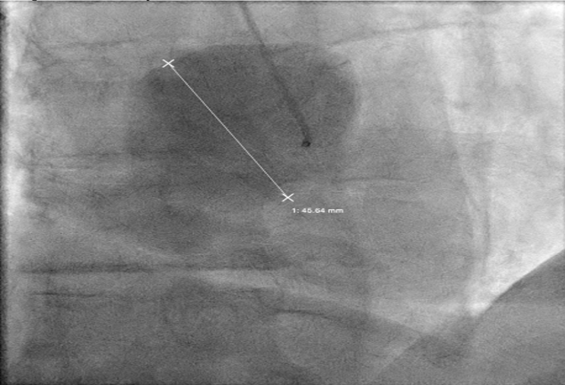 Figure 3. Giant proximal right coronary artery (RCA) aneurysm measuring 46 mm, with minimal filling of distal artery.
