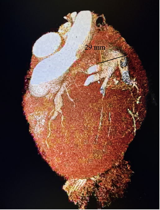 Figure 5. Cardiac CT 3D rendition showing giant circumflex artery aneurysm measuring 29 mm.  