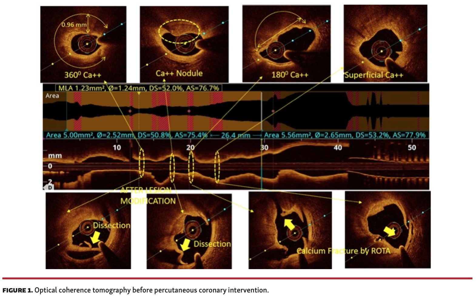 Chhikara Stuck OCT Catheter Figure 1