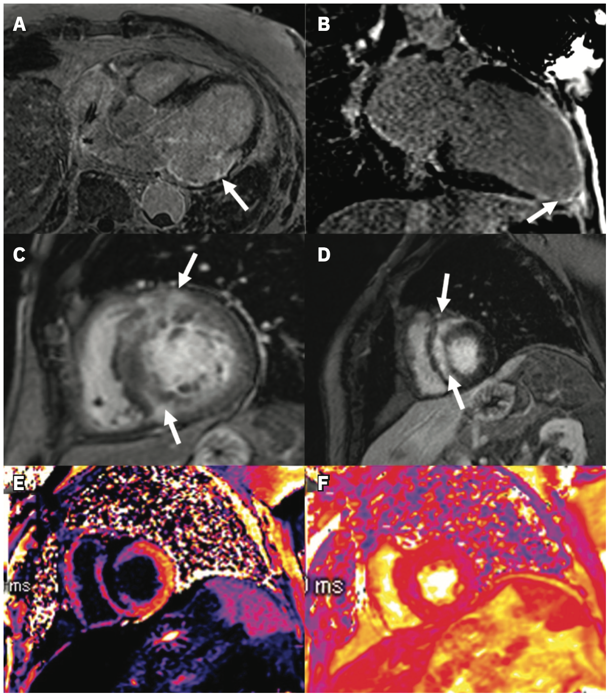 Chrispin Ventricular Arrhythmia Figure 1