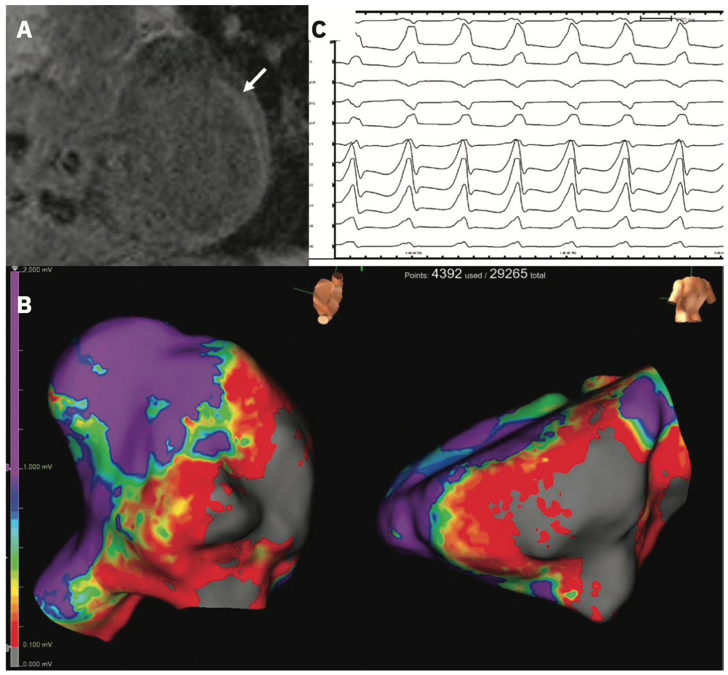 Chrispin Ventricular Arrhythmia Figure 2