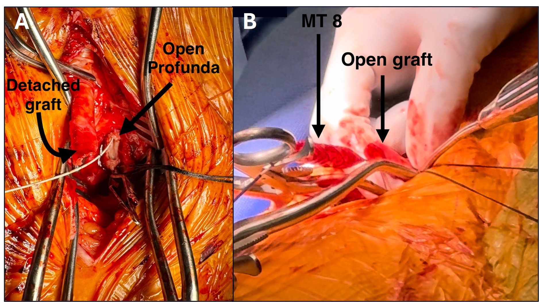 Figure 2. Intraoperative image of the (A) detached axillary-profunda bypass graft and open profunda (B) Artix MT8 thrombectomy device (Inari Medical) after it was removed from the graft.  
