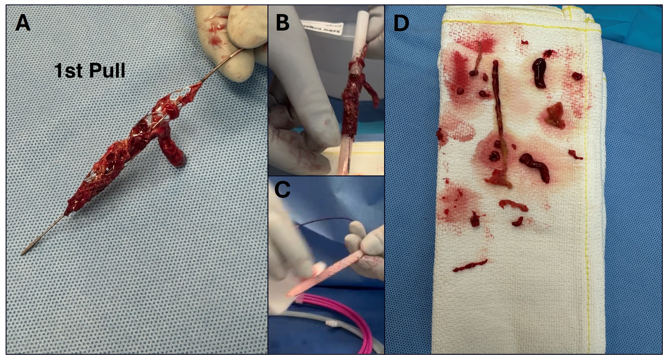 Figure 3. (A) Mixed chronicity with predominantly subacute-appearing thrombus within the Artix MT8 thrombectomy device element after the first pass. (B) Thrombus is removed from the element using a cleaning accessory. (C) Element and cleaning accessory after thrombus removal. (D) Additional thrombus removed after three additional passes with the Artix device. 