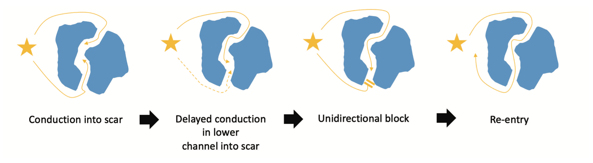 Dhanjal Ventricular Tachycardia Figure 1