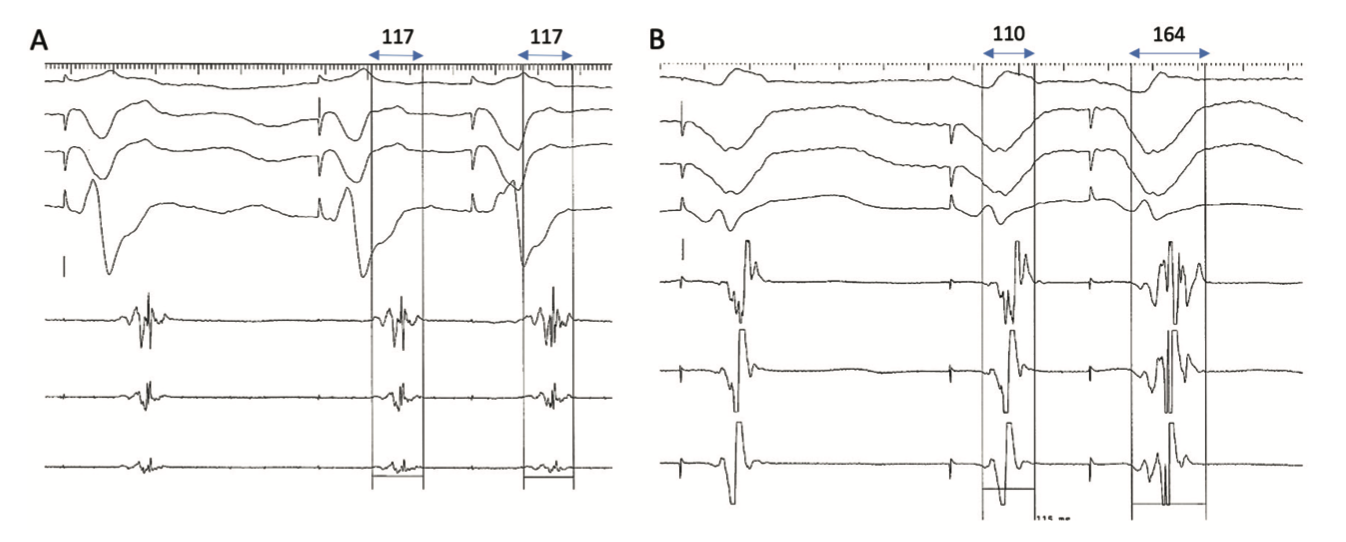 Dhanjal Ventricular Tachycardia Figure 2