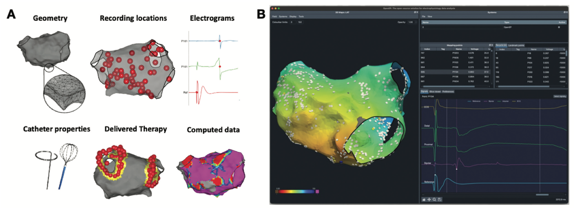 Dhanjal Ventricular Tachycardia Figure 3