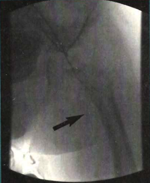 Figure 1. Contralateral injection showing total occlusion of the arterial supply to the left lower extremity (arrow).