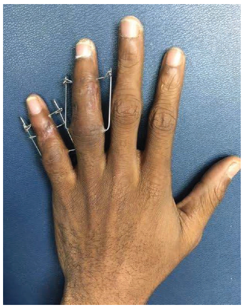 Dynamic External Fixation for Interphalangeal Comminuted Fractures