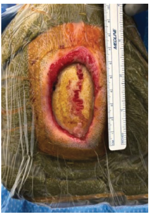 Figure 1 Meunier Dermatillomania