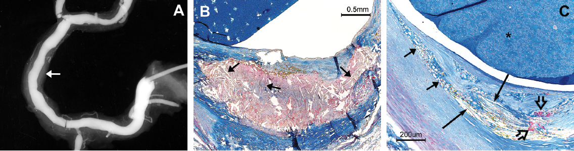 Figure 1. (A) X-ray of dissected right coronary artery (RCA) in a 69-year-old male who died within 24 hours following coronary bypass surgery. (B and C) Low- and high-power views of a plaque in the mid portion of the artery (short white arrow) in A. (B) An atheroma with CC distributed at random throughout the necrotic core (short black arrows). (C) The shoulder region of the plaque shows that the cholesteral crystals (CCs) are aligned parallel (long black arrows) and pointing towards the plaque shoulder in a tract containing many foam cells (short black arrows). A few red blood cells (RBCs) (yellow stain) and a small amount of fibrin (open arrows) are present adjacent to the CCs. Black asterisk = lumen containing blue injection mass. Martius Scarlet Blue (MSB) stain. Figure 1C, reprinted with permission.