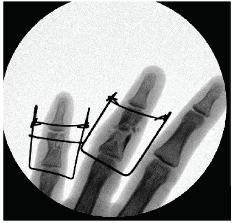 Figure 2 Luthringer Mallet