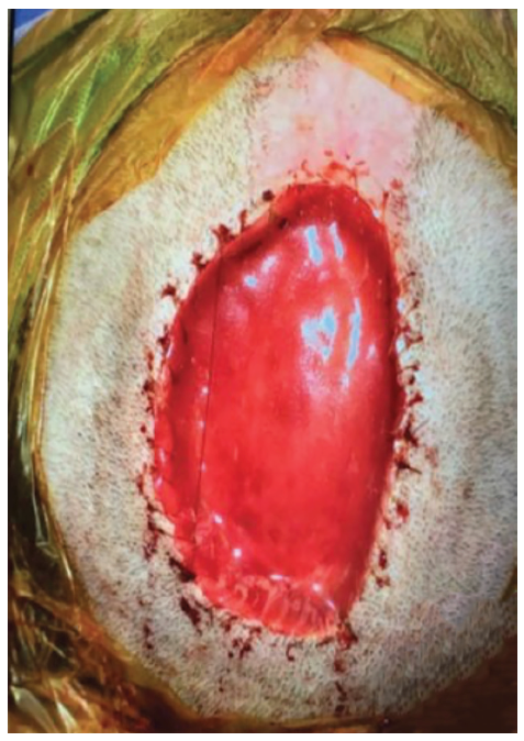 Figure 2 Meunier Dermatillomania