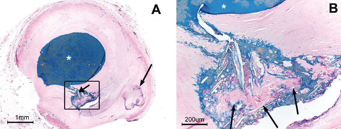 Figure 2. (A) Section taken from the proximal right coronary artery in a 73-year-old male who died in-hospital three weeks following an acute anterior myocardial infarction. A fissure containing cholesterol crystals (short black arrow) is present without luminal thrombosis. A focus of calcification is nearby (long black arrow). (B) High-power view of the fissure shows the core contains a small intra-intimal thrombus (long black arrows). White asterisk = lumen containing blue injection mass. Hematoxylin and eosin (H&E) stain.