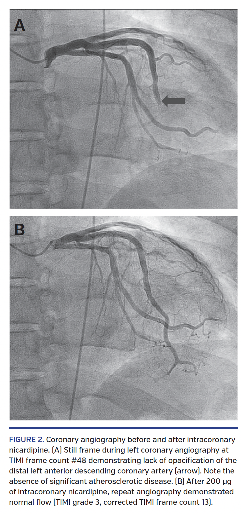 Coronary angiography before and after intracoronary nicardipine.