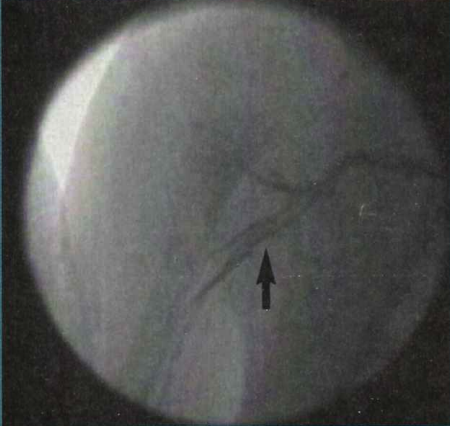 Figure 3. On the second intervention (Case 2), the patient still had a large thrombus in the axillary artery (arrow).