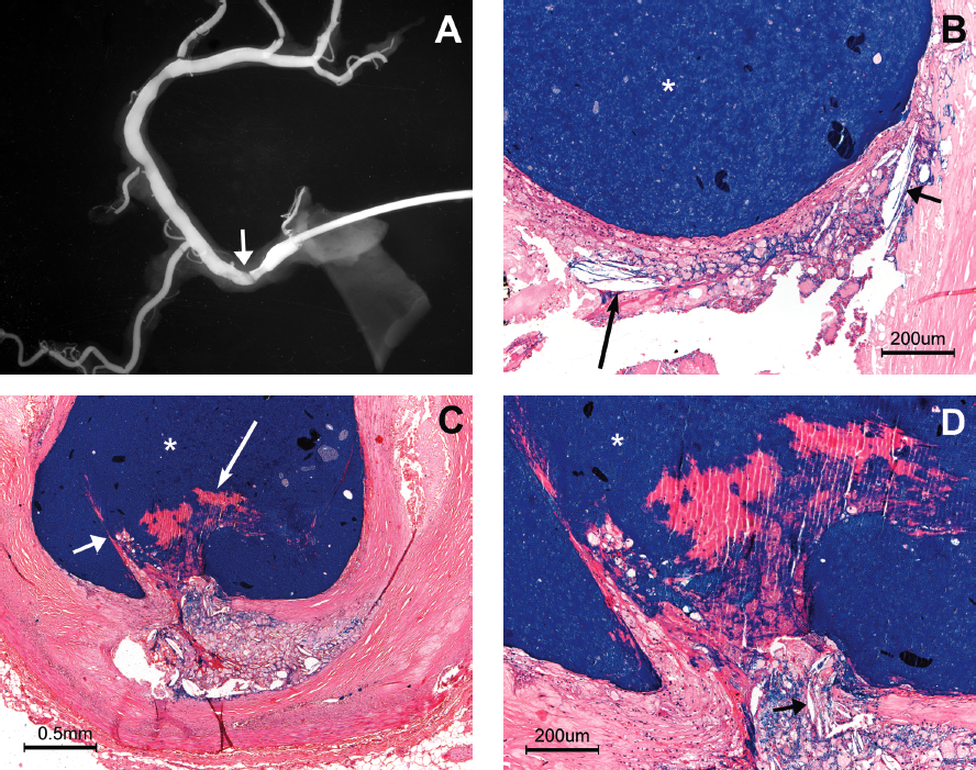 Figure 3. (A) X-ray of dissected right coronary artery in an 81-year-old male who died of sudden cardiac death out-of-hospital. A filling defect is present near the ostium (short white arrow). (B) High-power view of a segment just proximal to the filling defect in panel A showing parallel cholesterol crystals (P-CCs) at the plaque shoulder (short black arrow) and a second focus of P-CCs lying just beneath the center of the fibrous cap (long black arrow), oriented parallel to the fibrous cap. (C) Plaque rupture at the site of the filling defect in panel A with edges of fibrous cap pointing into the lumen (short white arrow) and associated with a small nonocclusive luminal thrombus (long white arrow). (D) High-power view of the rupture site in panel C, showing P-CCs at the rupture site (black arrow). White asterisk = injection mass in the lumen. H&E stain. Figure 3C, reprinted with permission.