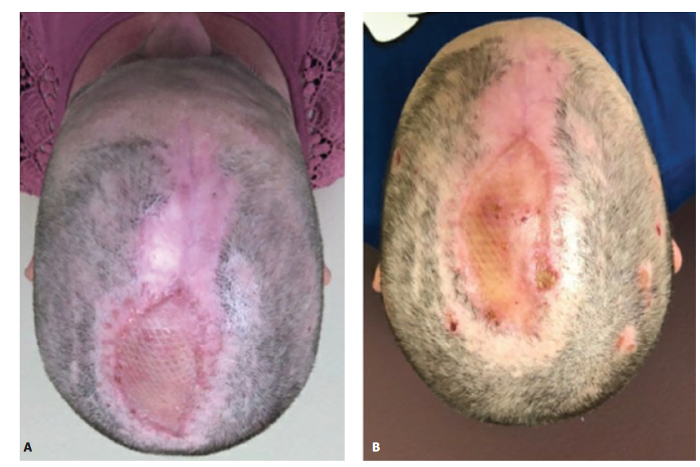 Figure 4 Meunier Dermatillomania