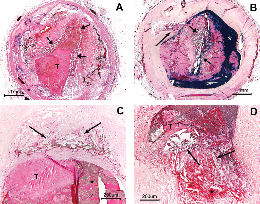 Figure 4. Shown here are four examples of parallel cholesterol crystals (P-CCs) in association with occlusive thrombosis. (A) Section from the mid left anterior descending artery (LAD) in a 58-year-old male who died in-hospital of cardiogenic shock following an acute anterior myocardial infarction. The occlusive thrombus is almost entirely surrounded by P-CCs that appear to be localized to the subendothelial region of the underlying plaque, but not mixed with the thrombus (short black arrows). (B) Thrombus in the mid right coronary artery (RCA) from a 58-year-old male who died of sudden cardiac death (SCD) out-of-hospital. The center of the thrombus contains a core of P-CCs (short black arrows). Plaque rupture is present beneath the thrombus (long black arrow). White asterisk = injection mass in the lumen. (C) Thrombus in the proximal LAD in a 32-year-old male who died SCD out-of-hospital. The thrombus, located at a point of > 80% stenosis, does not contain P-CCs, but P-CCs are mixed with injection mass in the atheroma directly beneath the thrombus (long black arrows). Black asterisk = injection mass in lumen. (D) Occlusive thrombus in the RCA in a 78-year-old female who suffered an acute inferior myocardial infarction followed by cardiac rupture. High-grade stenosis plus plaque rupture are present with hemorrhage (black asterisk), as well as P-CCs (long black arrows) in the plaque directly beneath the thrombus. All photos H&E stain. T = thrombus.