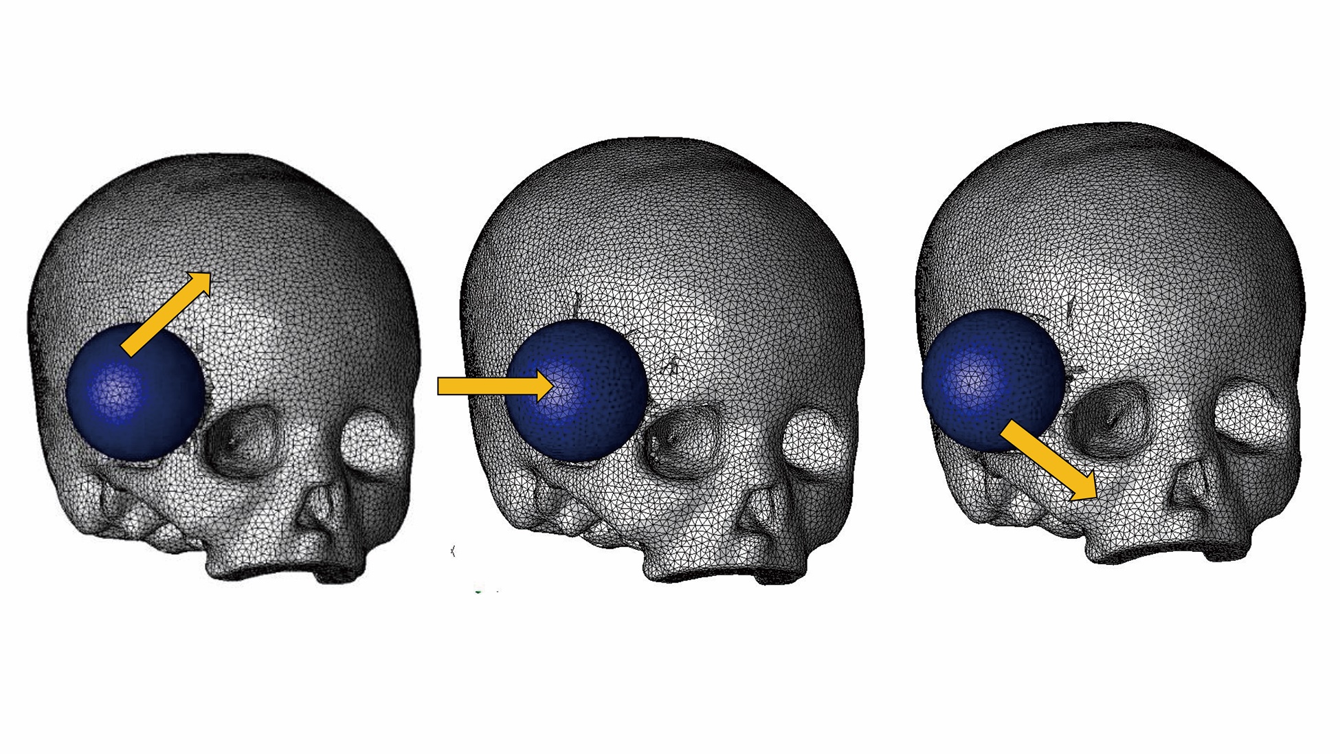 Hinge Fracture Skull