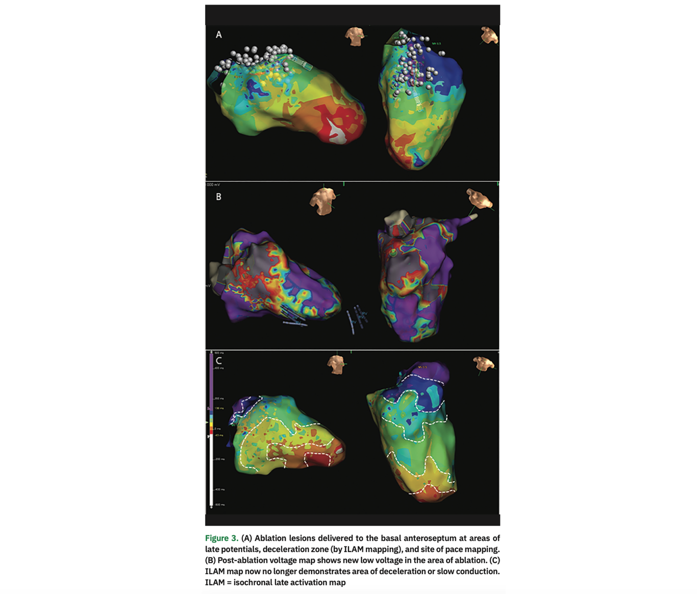 Goldstein Catheter Ablation Figure 3