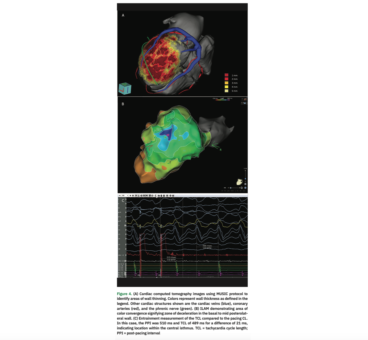 Goldstein Catheter Ablation Figure 4