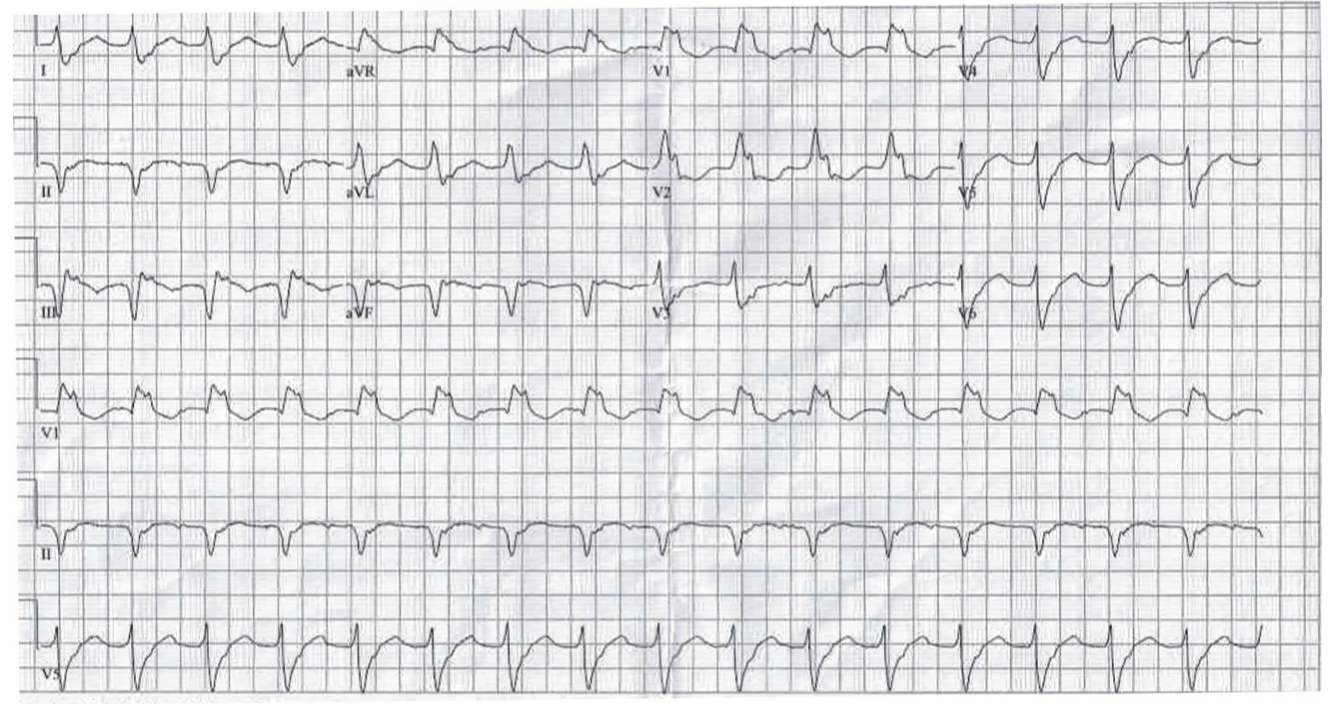 Harding Ventricular Tachycardia Figure 1