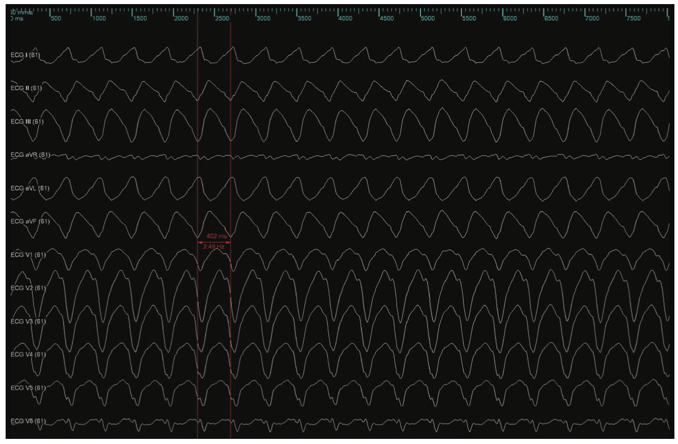 Harding Ventricular Tachycardia Figure 3