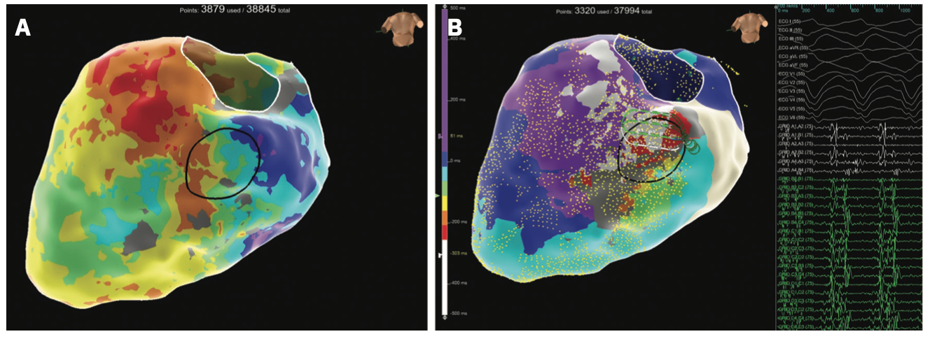 Harding Ventricular Tachycardia Figure 4