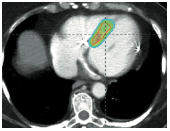 Harding Ventricular Tachycardia Figure 6