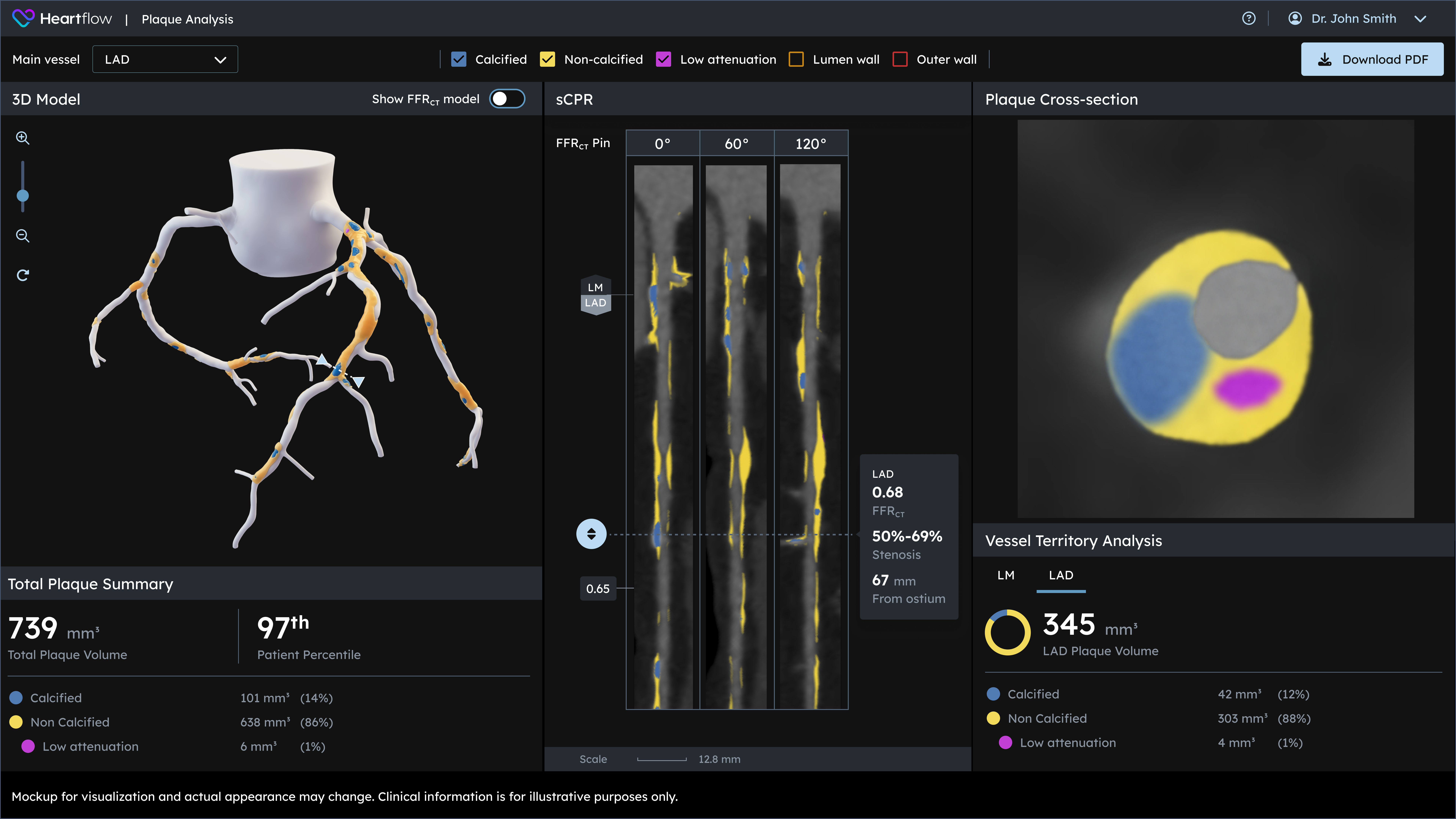 Heartflow Plaque Analysis