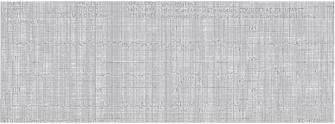 Figure 1. Initial ECG showing ST-elevation in inferior and lateral leads.