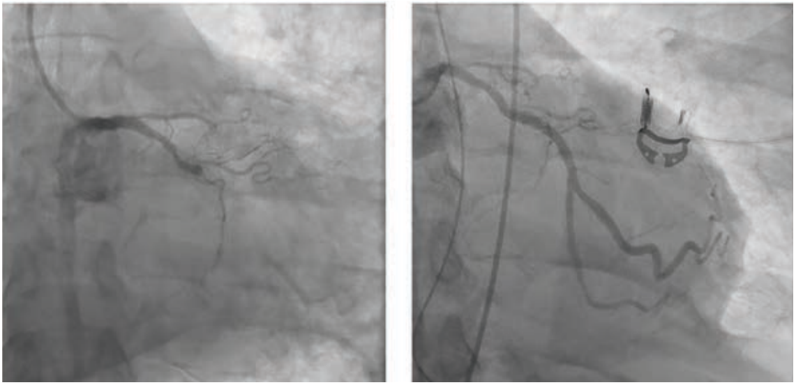 Figure 2. Cineframes showing acute occlusion of the circumflex artery before (left) and after (right) stenting.