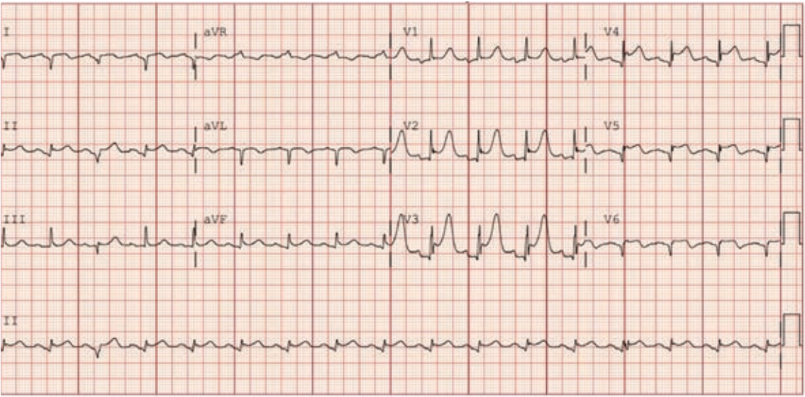 Figure 4. ECG after reperfusion with no-reflow and cardiogenic shock.  Note the ST segment elevation now in the anterior leads with persistent extensive Q waves.