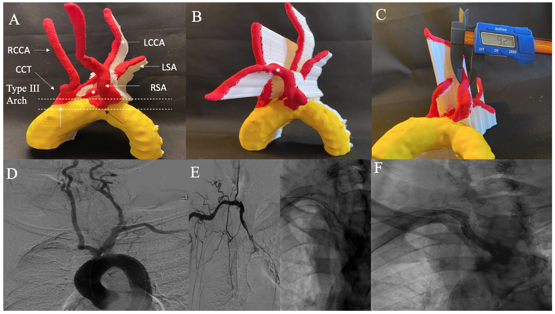 Memon Subclavian Artery Figure 1