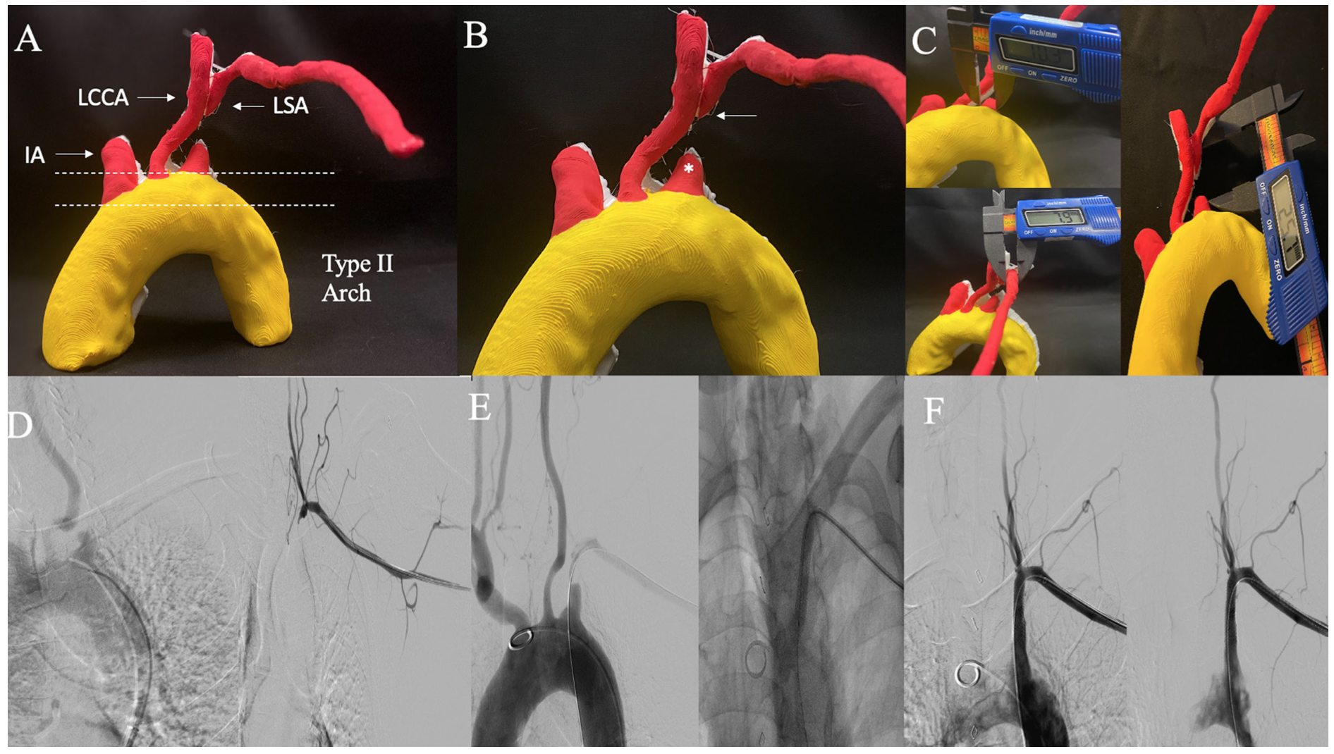 Memon Subclavian Artery Figure 2