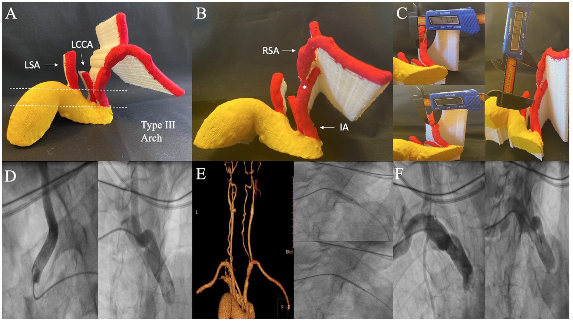 Memon Subclavian Artery Figure 3