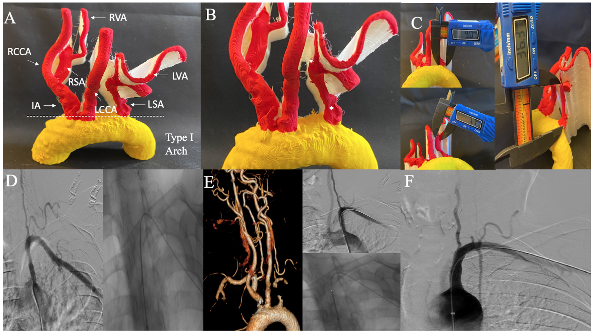 Memon Subclavian Artery Figure 4