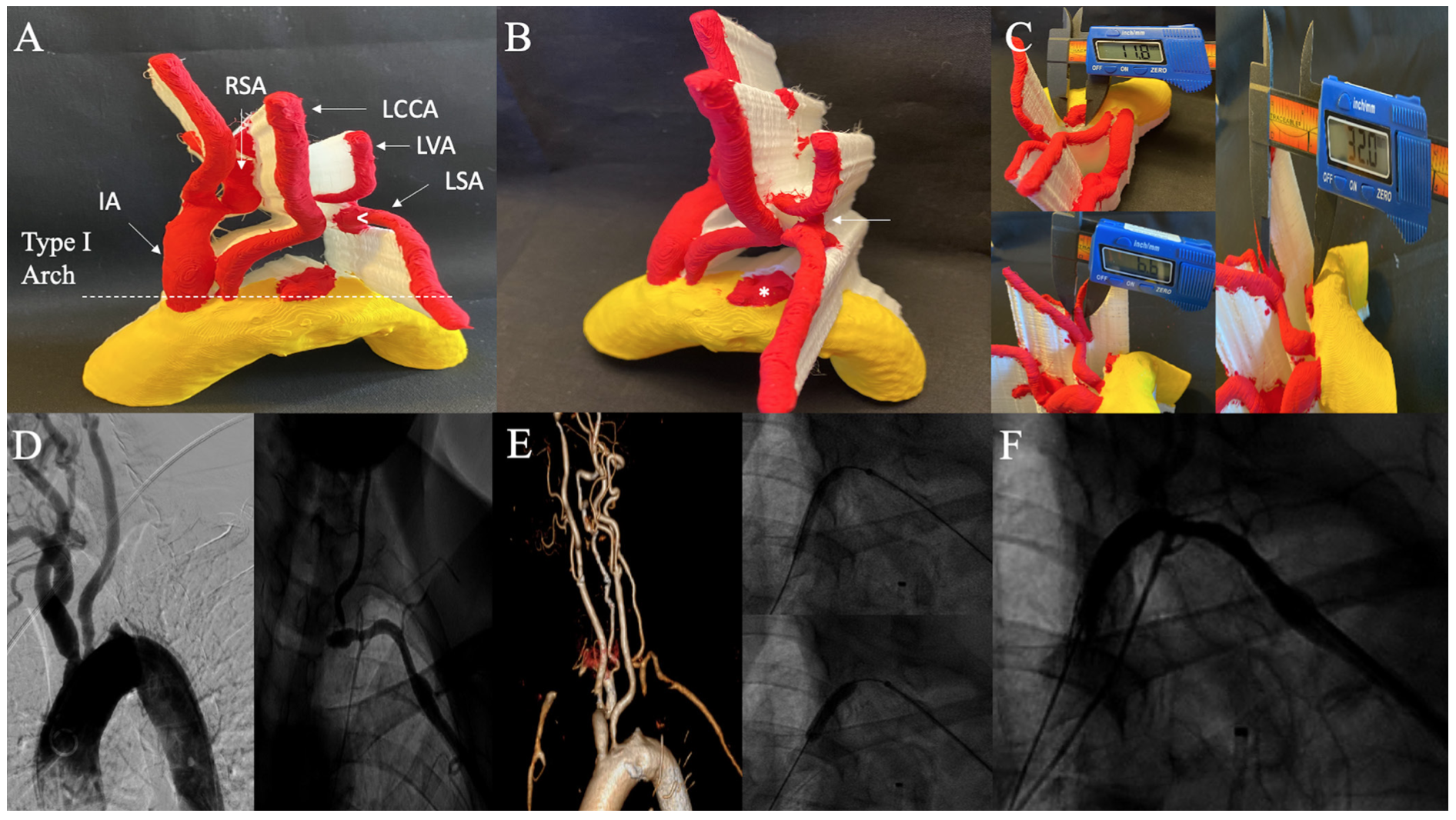 Memon Subclavian Artery Figure 5