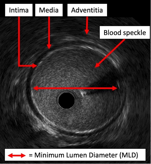 Figure 1. Intravascular ultrasound image with labeled components.