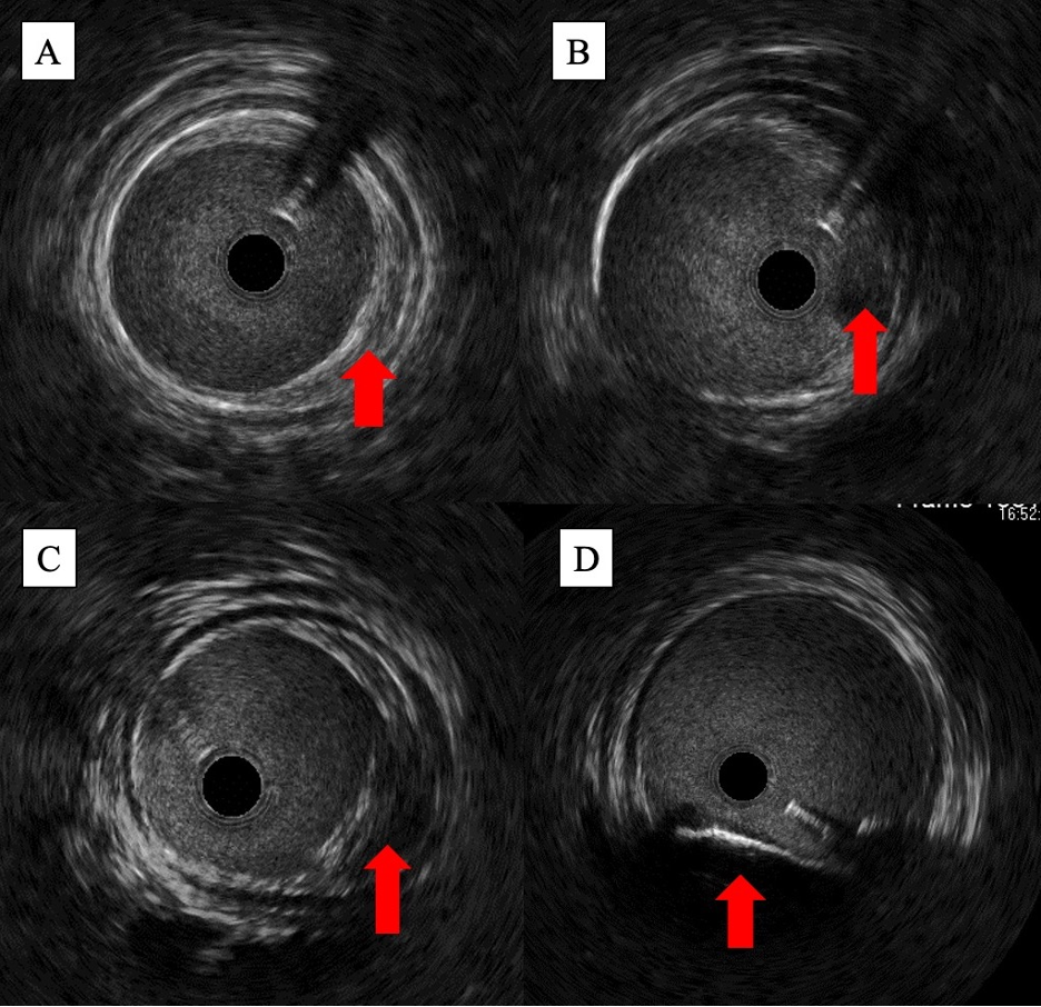 Figure 2. Examples of (A) fibrous plaque, (B) fatty plaque, (C) fibro-fatty plaque, and (D) calcific plaque on intravascular ultrasound.