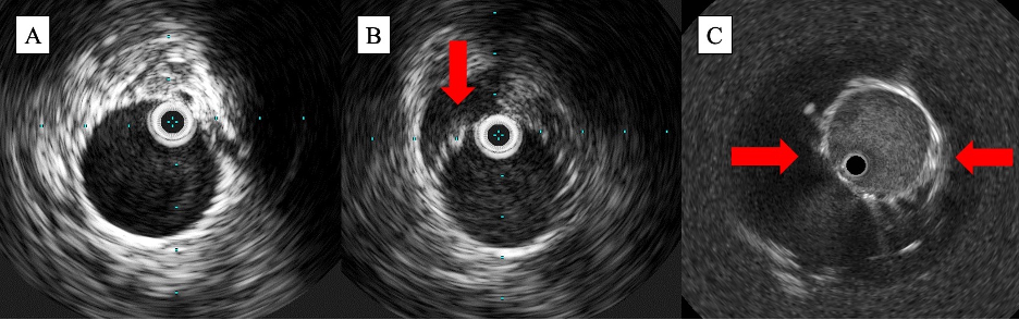 Figure 3. Intravascular ultrasound images identifying (A) a 360 well-apposed stent, (B) partial malapposition, and (C) 360 malapposition.  