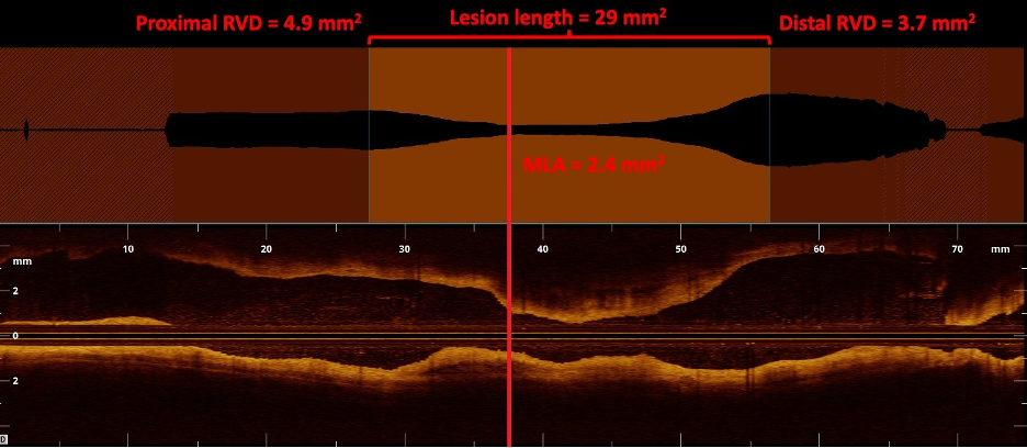 Figure 4. Optical coherence tomography imaging of a focal superficial femoral artery stenosis with relevant vessel measurements.