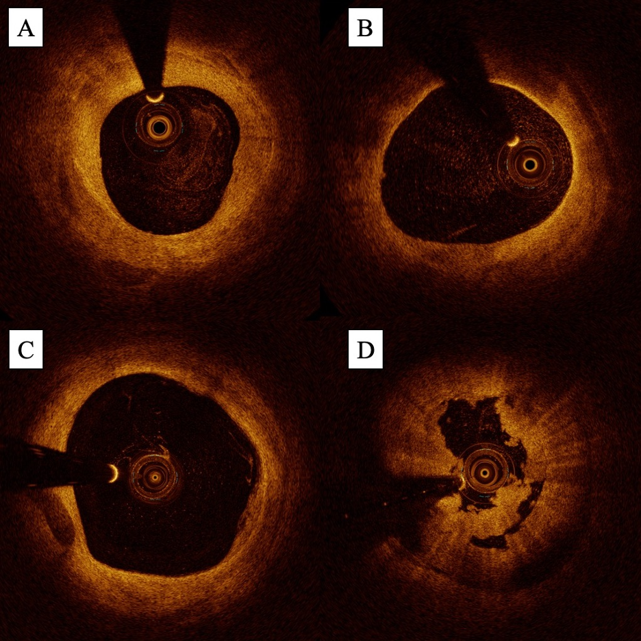 Figure 5. Examples of (A) fibrous plaque, (B) fatty plaque, (C) calcific plaque, and (D) white thrombus on optical coherence tomography.