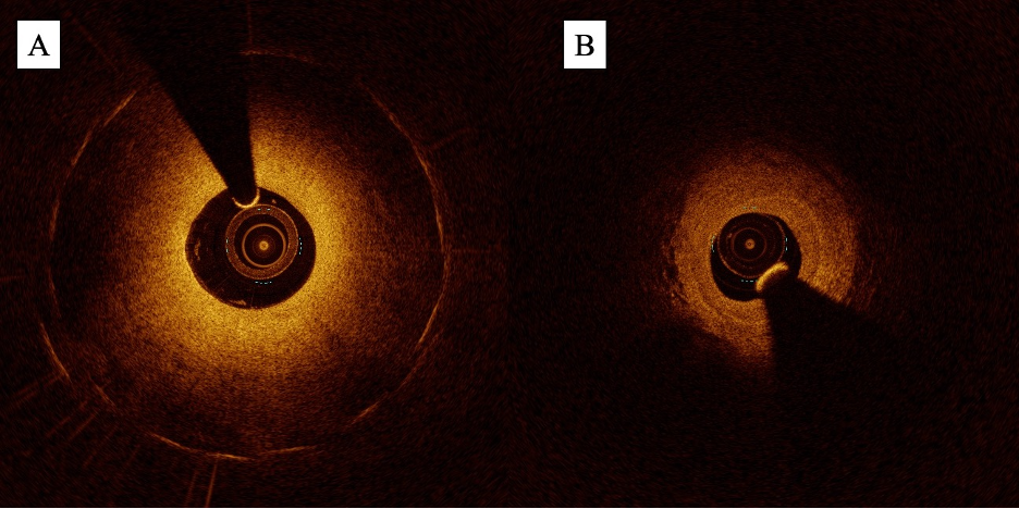 Figure 6. Optical coherence tomography images of (A) neointimal hyperplasia in a previously implanted stent, and (B) neointimal fibrotic hyperplasia in a previous bypass graft.