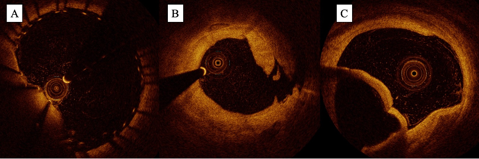 Figure 7. Optical coherence tomography images identifying (A) stent malapposition, (B) focal dissection, and (C) spiral dissection.