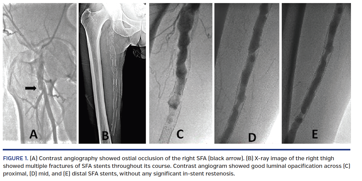 J INVASIVE CARDIOL 2020;32(1):E13 Figure 1