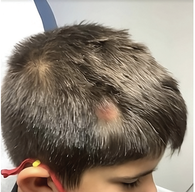 A pink, bald patch