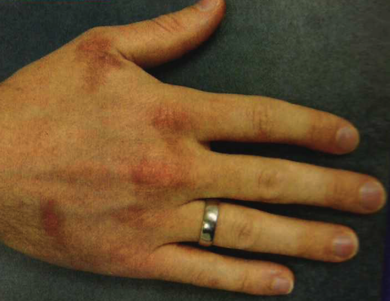 itchy hand