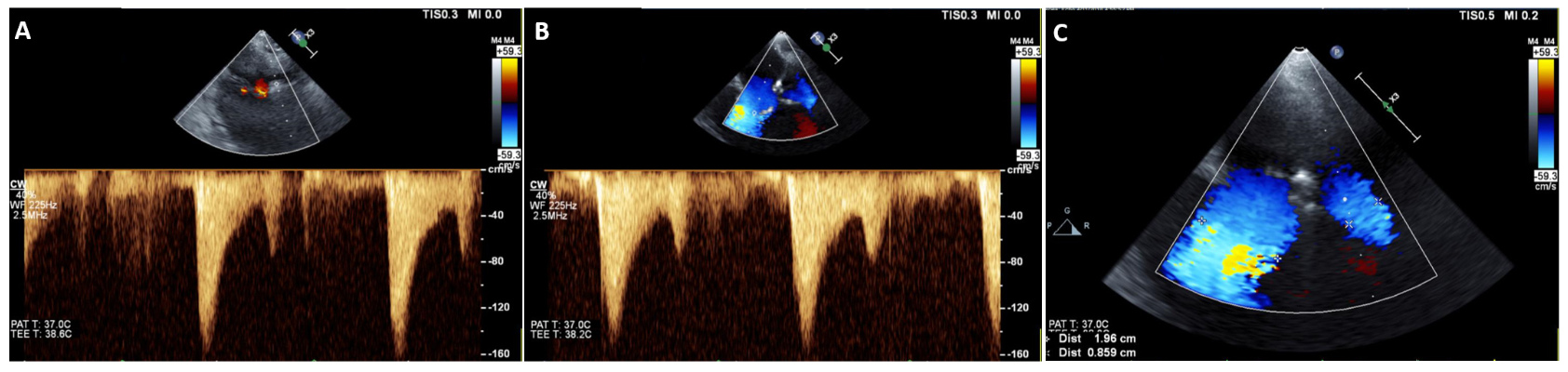 Singam Mitral Valve Figure 6